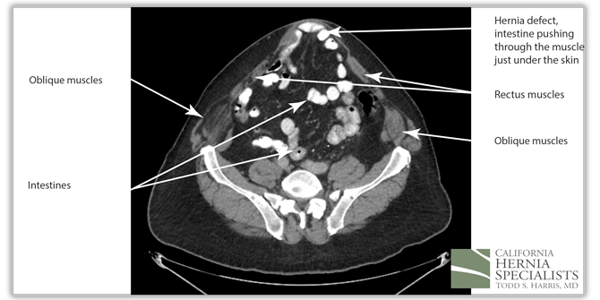 Recurrent Ventral Hernia CT Image